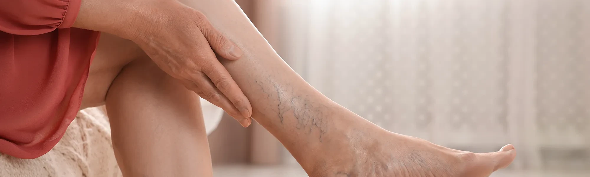 Venenöse Erkrankungen am Bein, sichtbare Besenreiser und Krampfadern