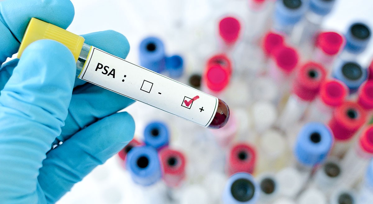 Prostata Hilfe Deutschland: Illustrationsbild - PSA-Test