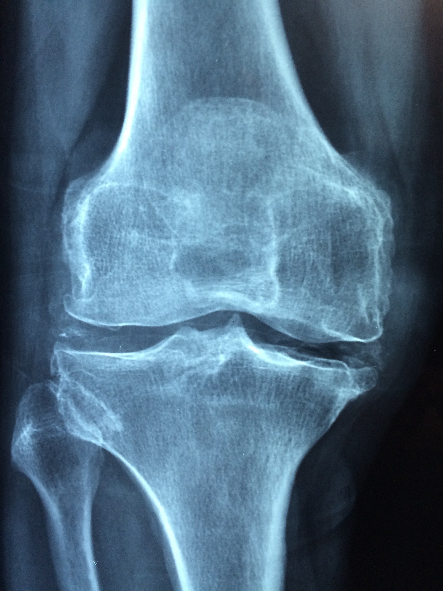 Osteoporose vorbeugen: Tipps für starke und gesunde Knochen