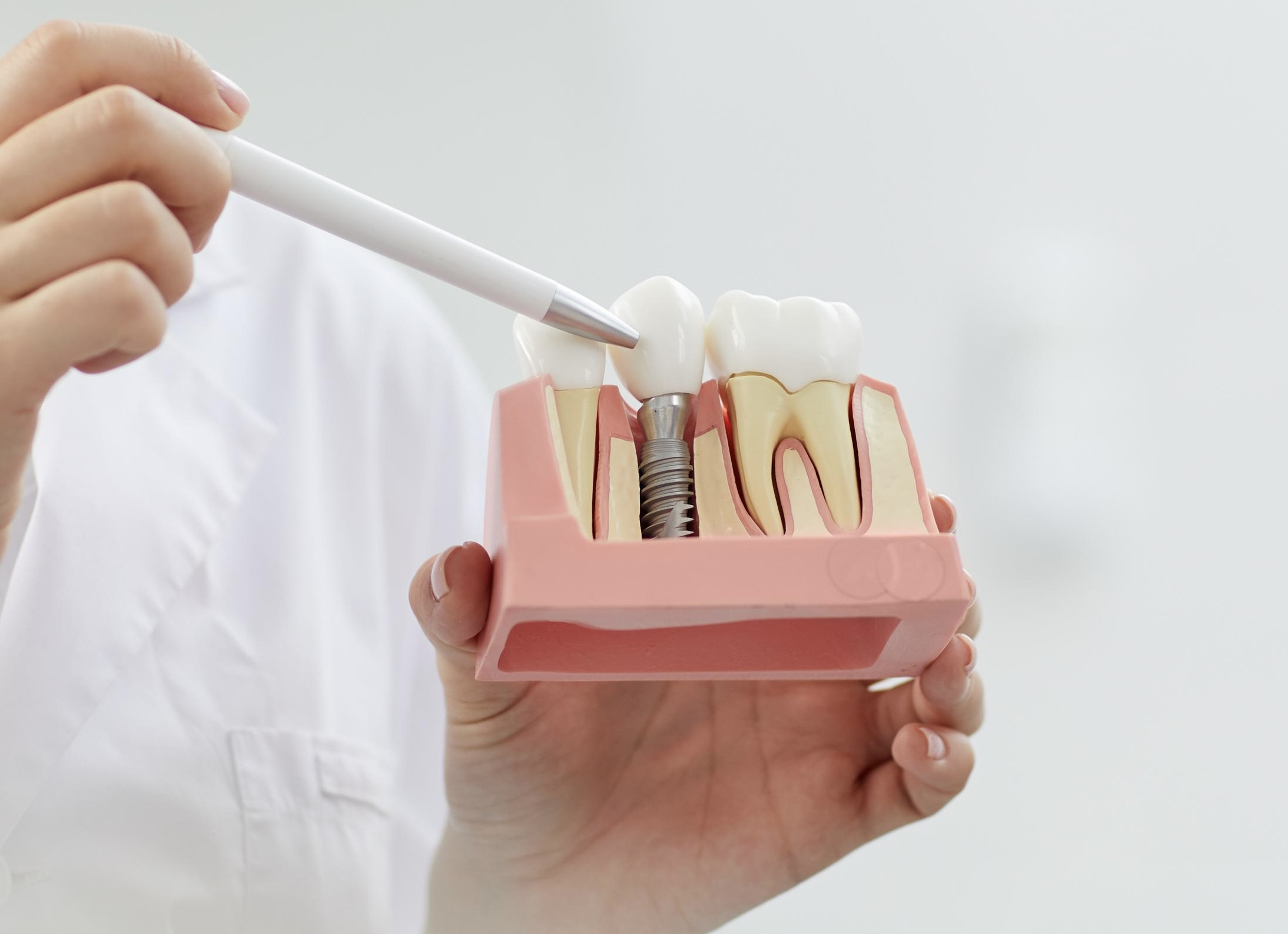 Zahnarzt zeigt mit Stift auf Zahnimplantat-Modell im Querschnitt