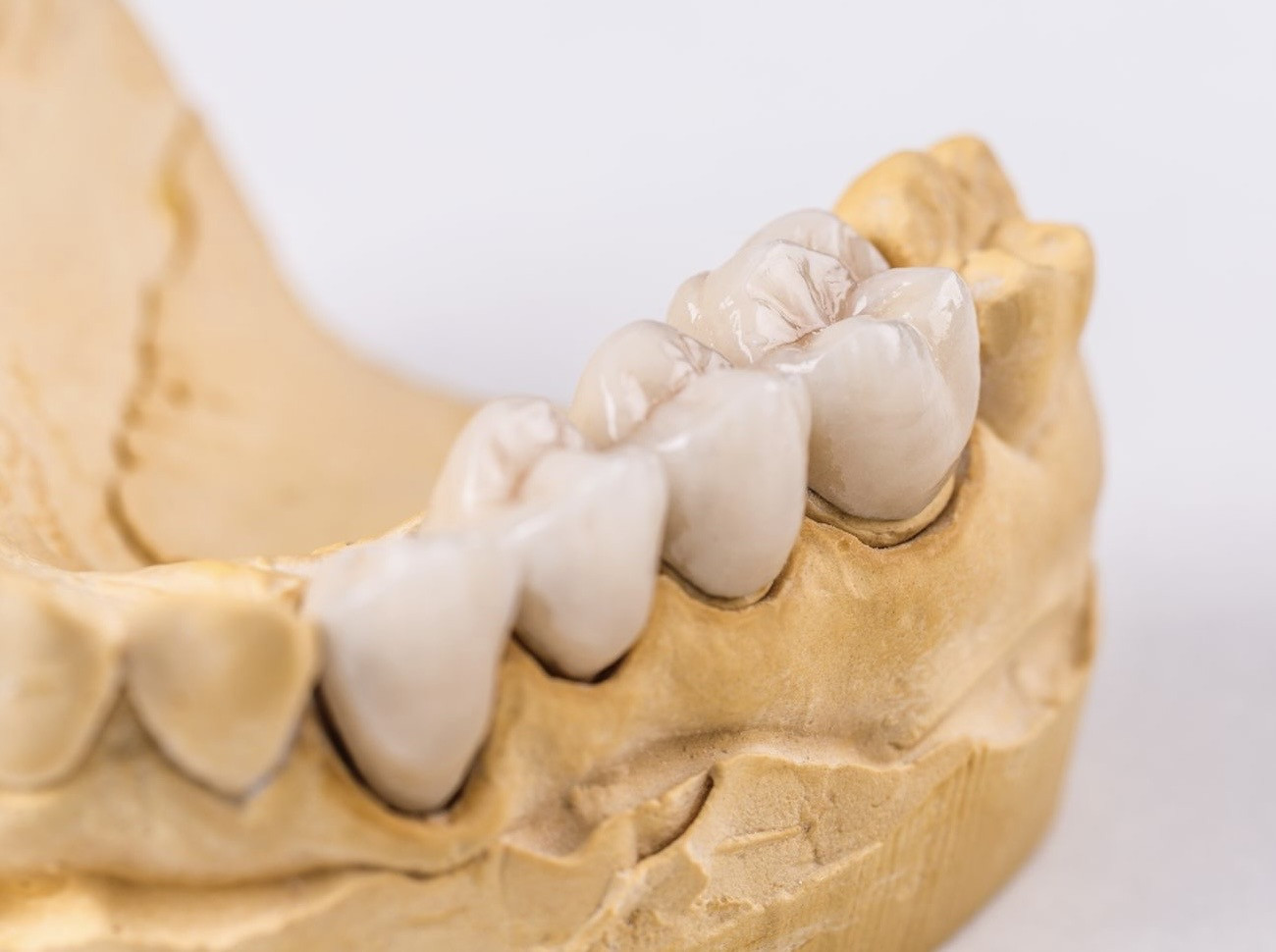 Zahnmodell mit Keramikkronen auf Backenzähnen, Detailaufnahme Zahntechnik