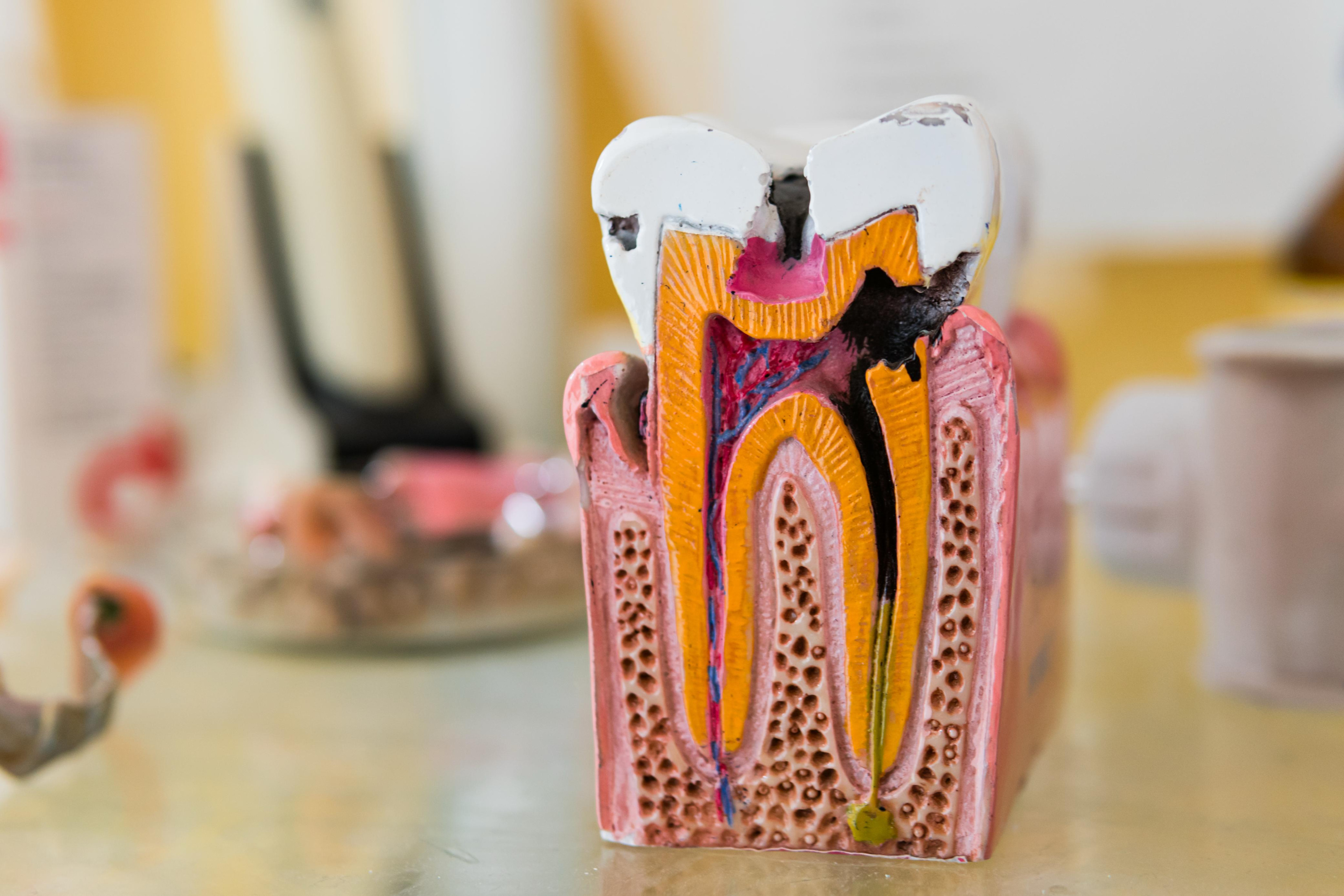 Anatomisches Zahnmodell mit Darstellung von Zahnstruktur und Karies