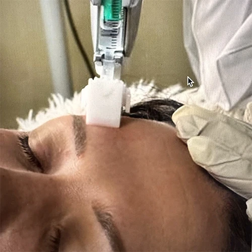 Vakuum Needling: Innovative Gesichtsbehandlung zur Hautverjüngung Vakuum Needling Behandlung im Gesicht zur Hautverjüngung