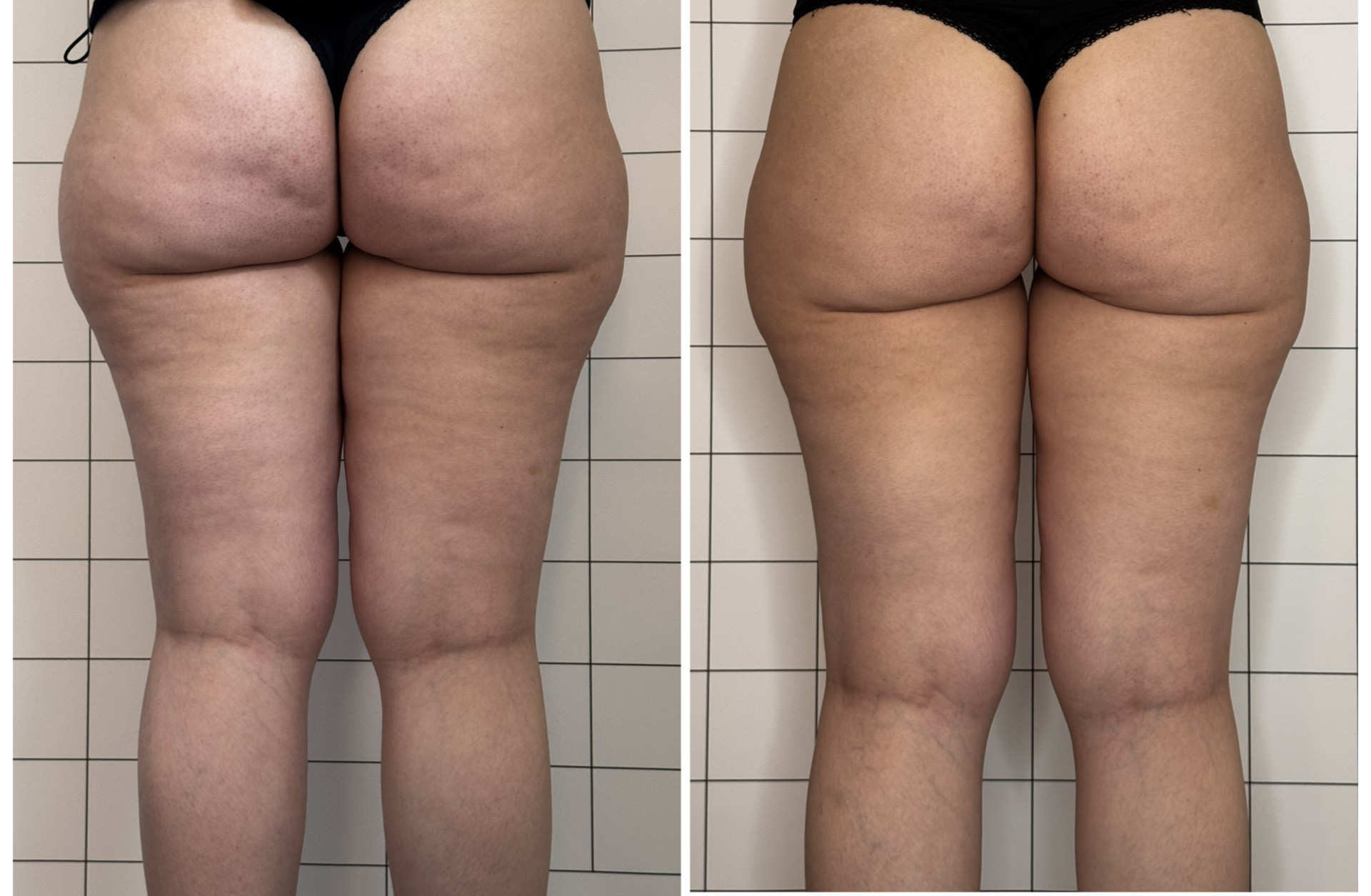 Vorher-Nachher Vergleich Cellulite Behandlung an Oberschenkeln und Gesäß einer Frau