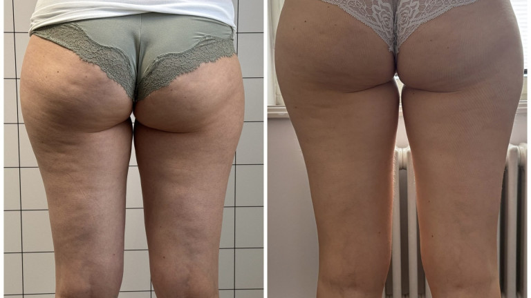 Cellulite Vorher-Nachher Ergebnis mit Onda Coolwaves in Konstanz Cellulite Vorher-Nachher Bild nach Onda Coolwaves Behandlung in Konstanz