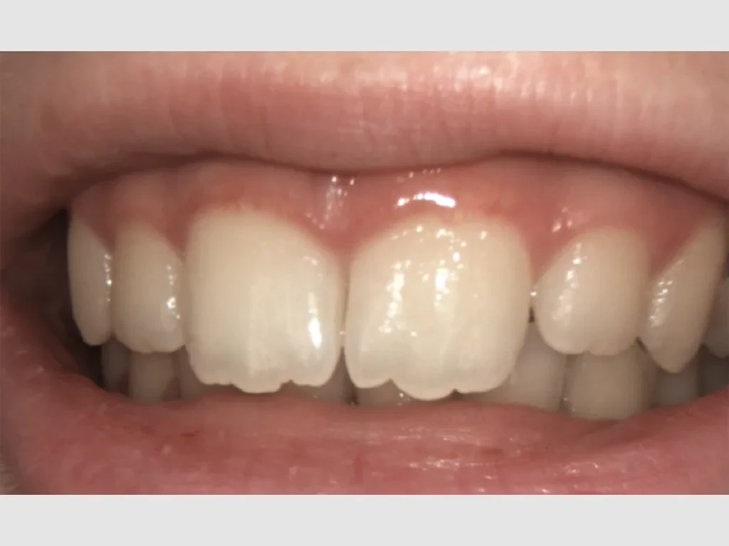 Nahaufnahme von Zähnen und Zahnfleisch als Teaserbild für Kieferorthopädie