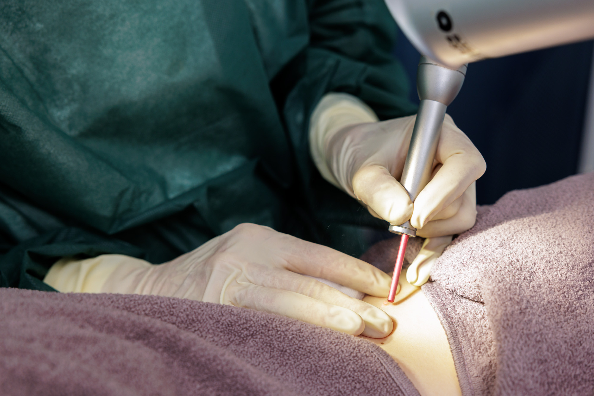 Praxisfoto 2025: Laserbehandlung in einer Arztpraxis, Detailaufnahme der Behandlung