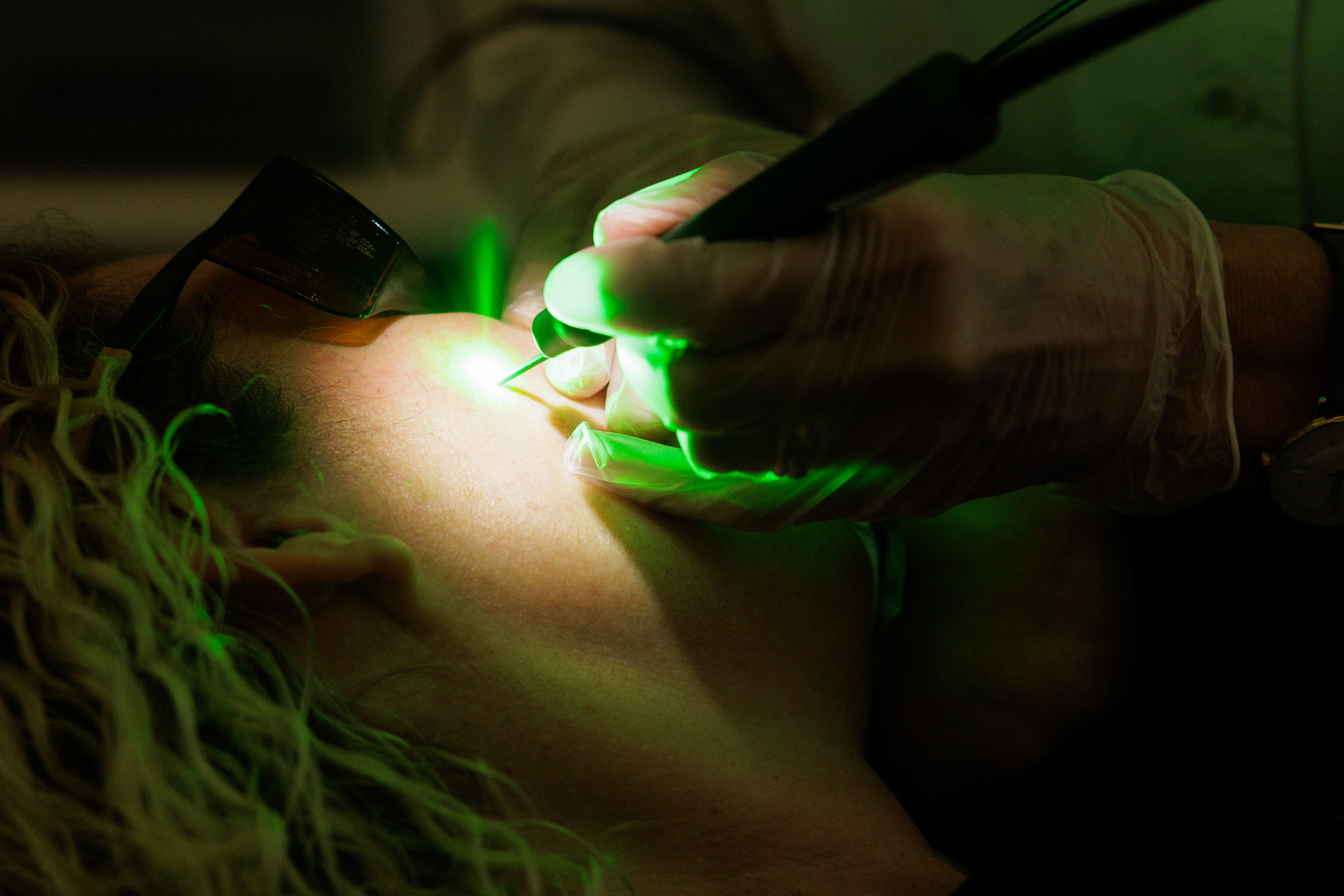 Praxisfoto 2025: Laserbehandlung im Gesicht durch medizinisches Fachpersonal