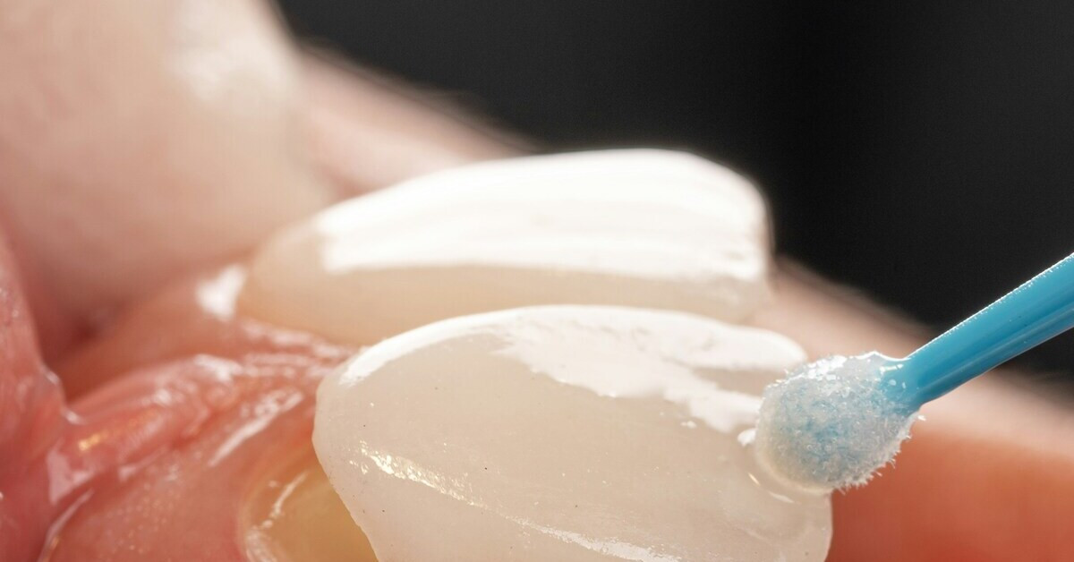 Nahaufnahme von Veneers auf Zähnen – hochwertige Zahnverblendungen für ein schönes Lächeln