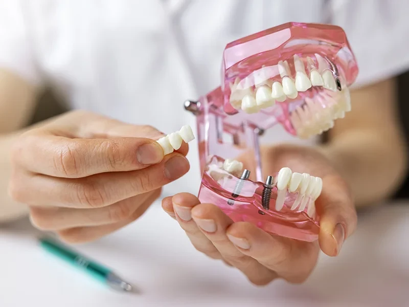 Zahnersatz und Implantat an einem Zahnmodell in der Hand eines Zahnarztes