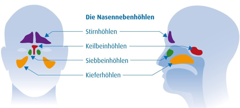 Grafik der Nasennebenhöhlen mit Stirnhöhlen, Keilbeinhöhlen, Siebbeinhöhlen und Kieferhöhlen