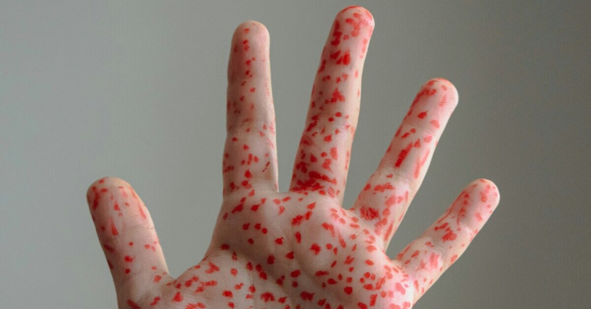 Stilisierte Darstellung eines Ausschlags auf einer menschlichen Hand