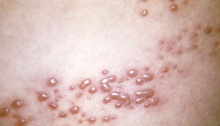 Gürtelrose (Herpes Zoster) mit typischem Hautausschlag und Bläschenbildung