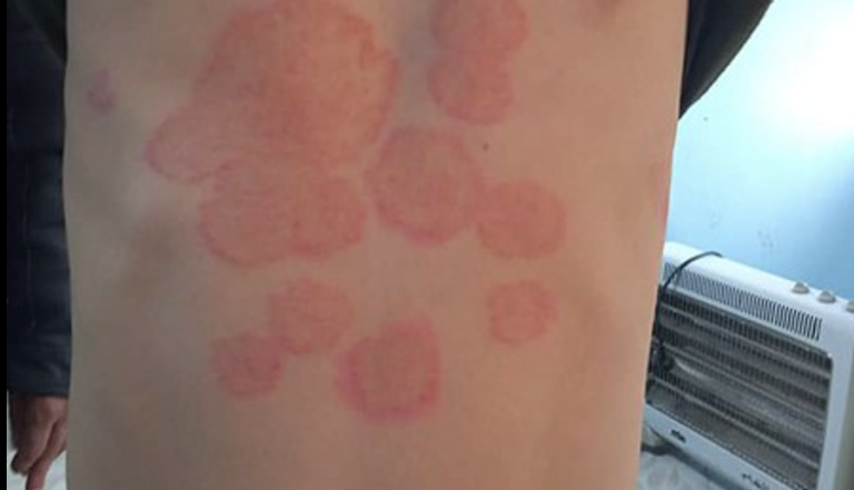 Tinea-Infektion mit typischen roten, runden Hautveränderungen auf dem Rücken