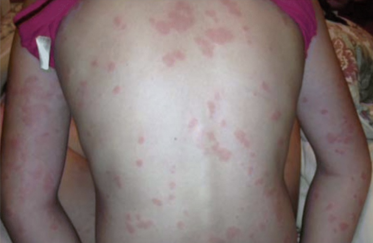 Urtikaria auf dem Rücken eines Patienten, rote Quaddeln und Hautausschlag sichtbar