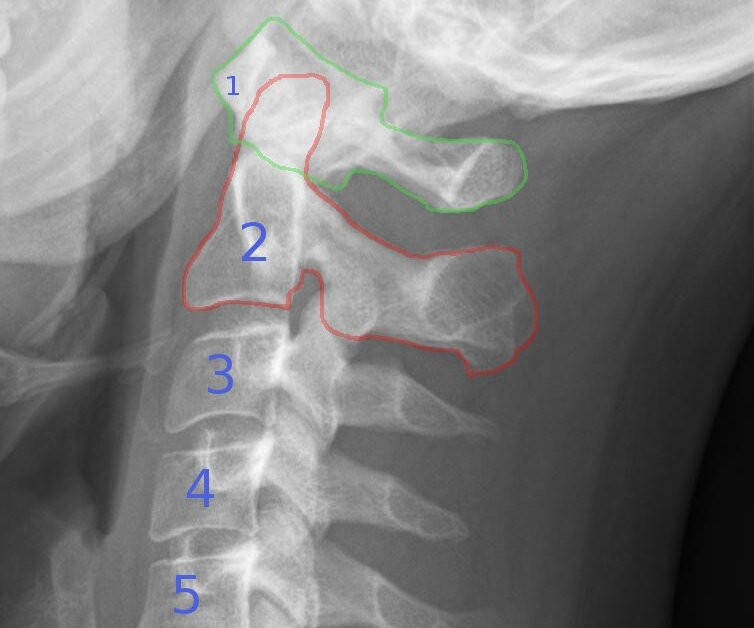 Röntgenbild der Halswirbel mit Markierungen und Nummerierung der Wirbelkörper