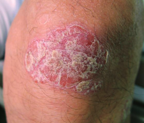 Psoriasis auf der Haut – typisches Erscheinungsbild einer Schuppenflechte