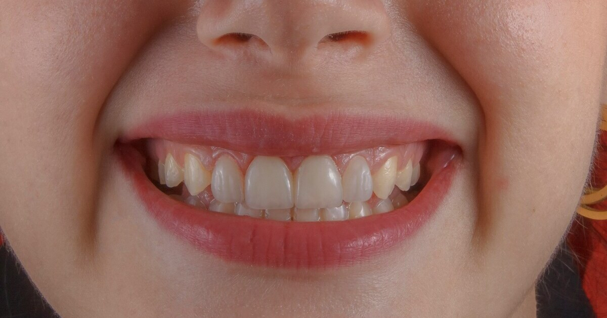 Lächelnder Mund mit gesunden Zähnen