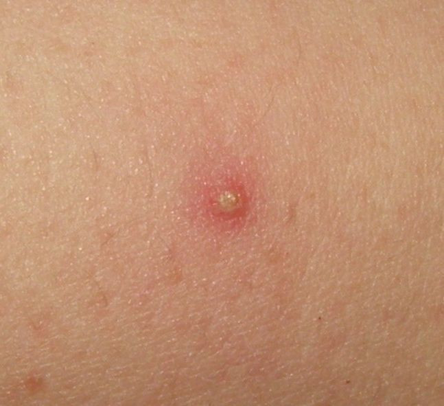 isolated folliculitis auf menschlicher Haut, Nahaufnahme eines einzelnen entzündeten Haarfollikels