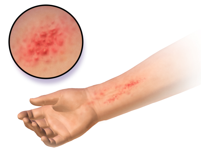 Kontaktdermatitis am Unterarm mit geröteter, entzündeter Hautstelle