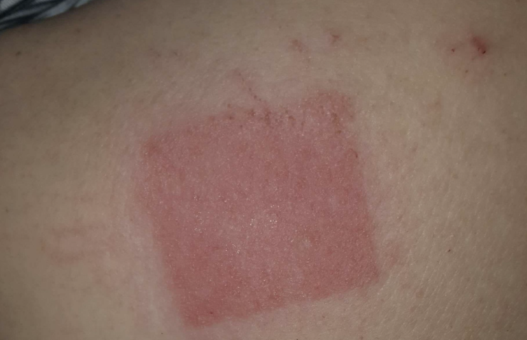 Allergische Reaktion auf der Haut nach Pflasteranwendung, gerötete und gereizte Hautstelle